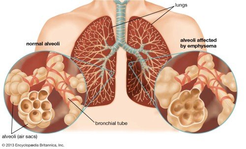 Lung disease