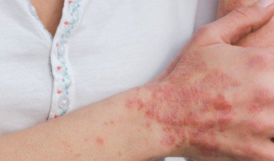 Psoriasis: Causes, Symptoms, Treatment
