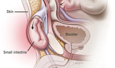 Inguinal Hernia: Symptoms, Diagnosis, and Treatment Options