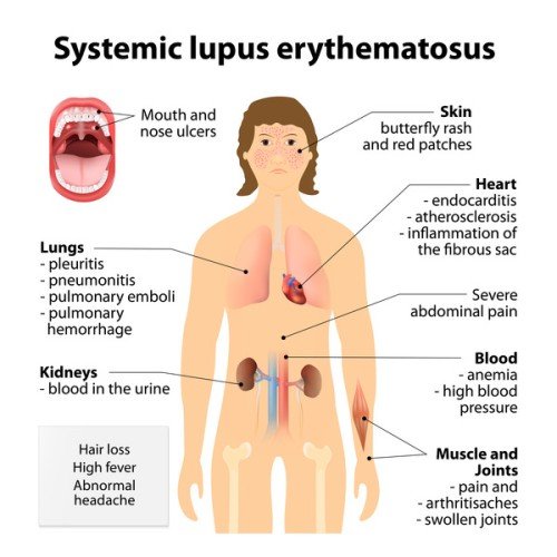 Unveiling the Mysteries of Lupus: Understanding an Invisible Disease