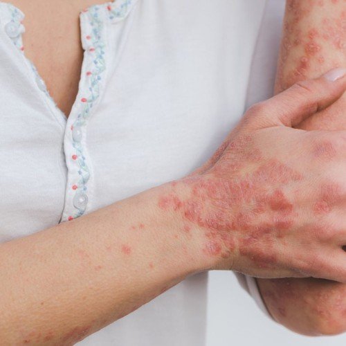 Psoriasis: Causes, Symptoms, Treatment