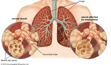 Lung disease